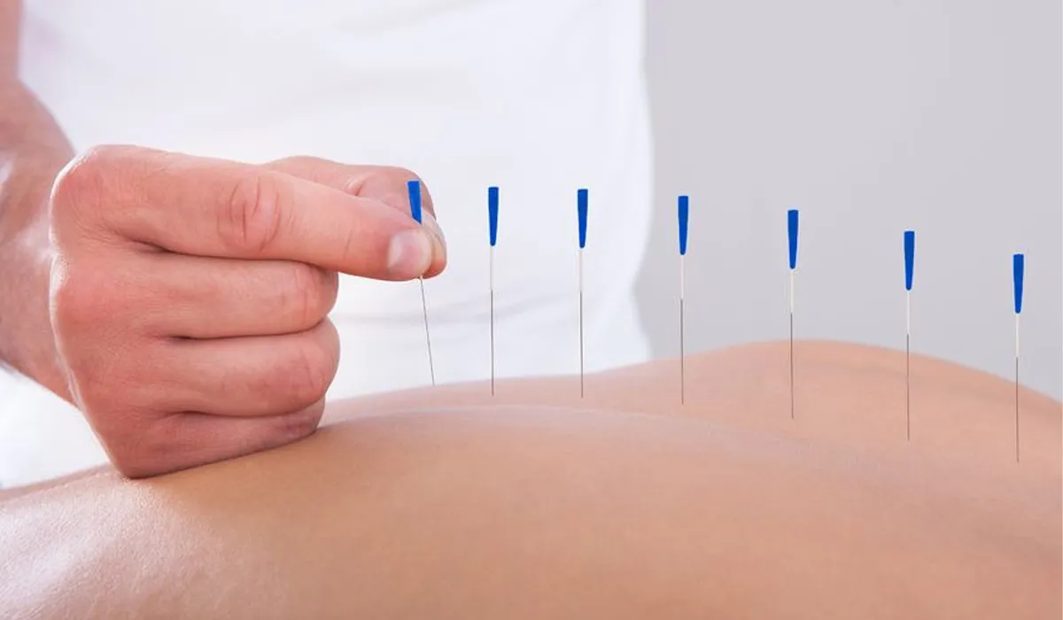 Acupuncture Therapy Service in CIT Nagar, Nandanam by Miracle Acupuncture Wellness Centre