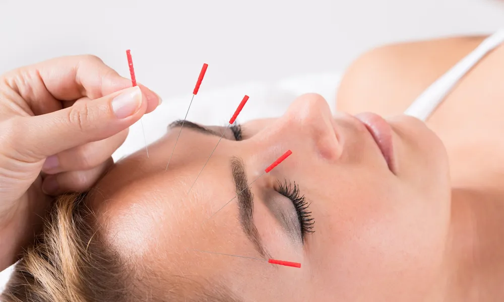 Acupuncture Therapy in Chennai at Miracle Acupuncture Wellness Centre