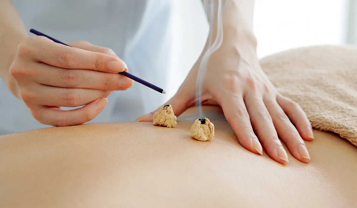 Moxibustion Therapy Treatment at Miracle Acupuncture Wellness Centre in CIT Nagar, Chennai