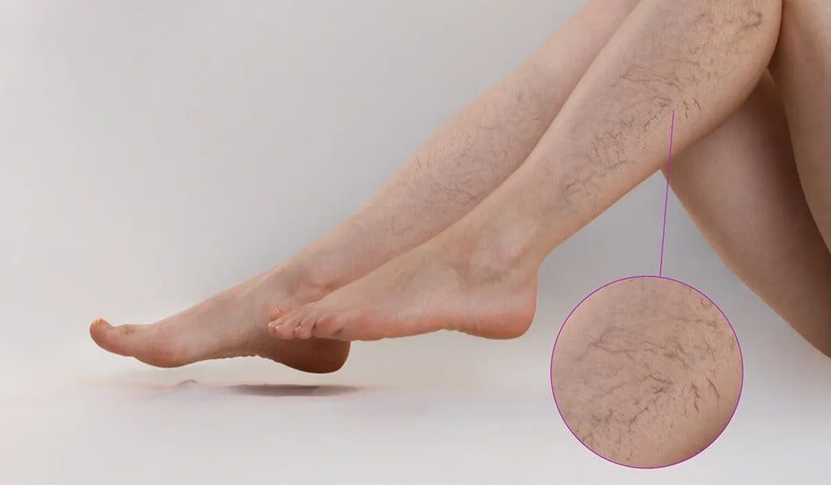 Varicose Vein Care Treatment in CIT Nagar, Nandanam at Miracle Acupuncture Wellness Centre